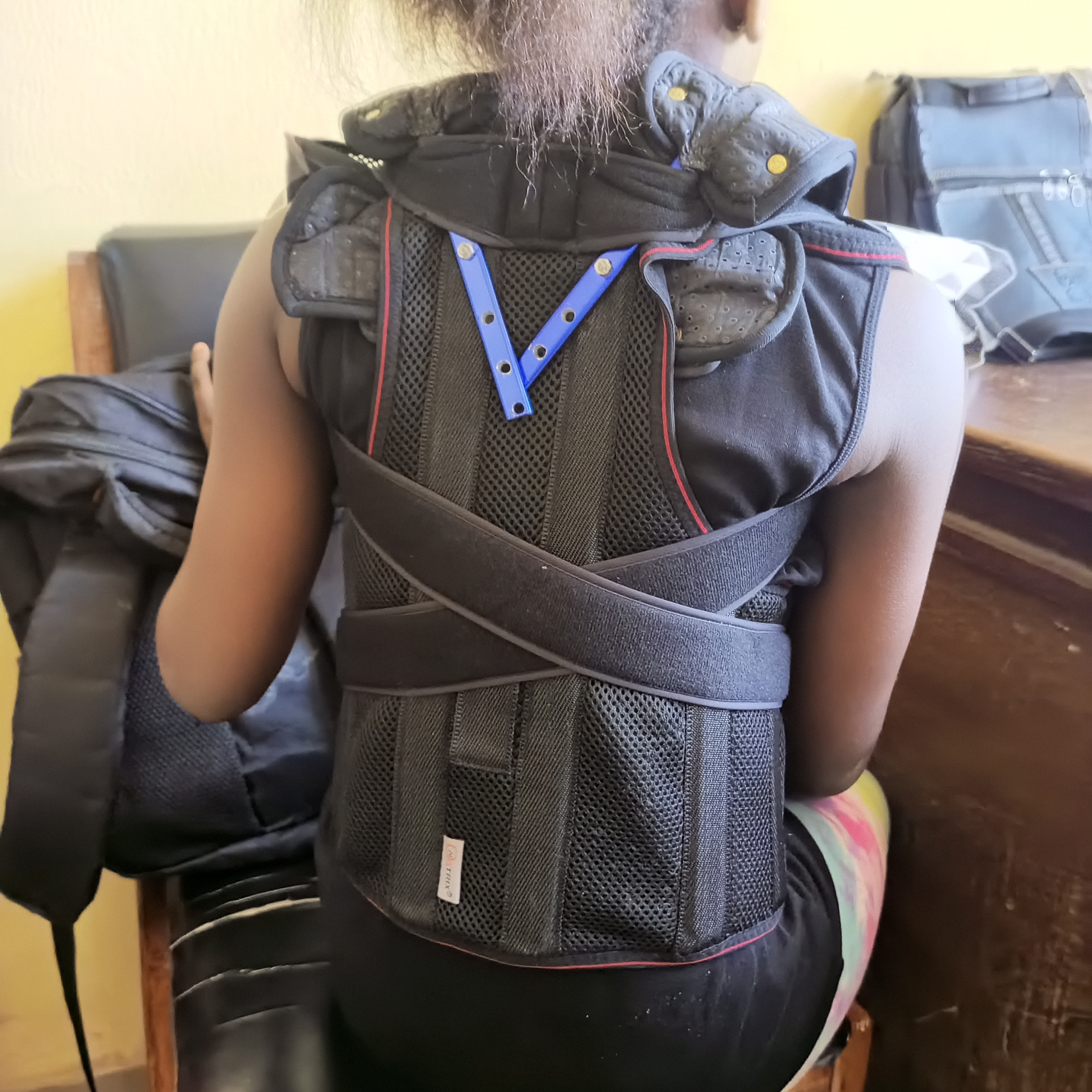 Prefabricated TLSO Spinal Support Brace